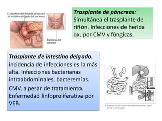 Trasplante de páncreas: 
Simultánea el trasplante de 
riñón. Infecciones de herida 
qx, por CMV y fúngicas. 
Trasplante de intestino delgado. 
incidencia de infecciones es la más 
alta. Infecciones bacterianas 
intraabdominales, bacteremias. 
CMV, a pesar de tratamiento. 
Enfermedad linfoproliferativa por 
VEB. 
 