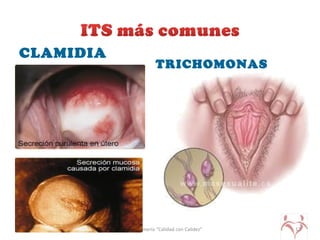 CLAMIDIA
TRICHOMONAS
UPLA-Enfermería “Calidad con Calidez” 12
 