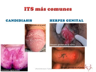 CANDIDIASIS HERPES GENITAL
UPLA-Enfermería “Calidad con Calidez” 13
 