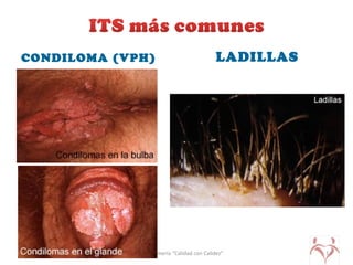 CONDILOMA (VPH) LADILLAS
UPLA-Enfermería “Calidad con Calidez” 14
 