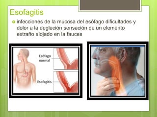 Esofagatis Infecciones gastrointestin original | PPTX