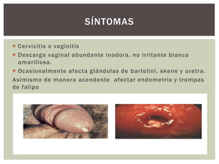  Cervicitis o vaginitis
 Descarga vaginal abundante inodora, no irritante blanca
amarillosa.
 Ocasionalmente afecta glándulas de bartolini, skene y uretra.
Asimismo de manera acendente afectar endometrio y trompas
de falipo
SÍNTOMAS
 