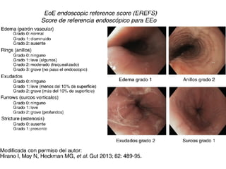 ESOFAGITIS INFECCIOSA