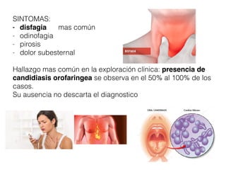 SINTOMAS:
- disfagia mas común
- odinofagia
- pirosis
- dolor subesternal
Hallazgo mas común en la exploración clínica: presencia de
candidiasis orofaringea se observa en el 50% al 100% de los
casos.
Su ausencia no descarta el diagnostico
 