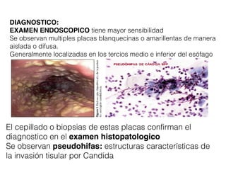 DIAGNOSTICO:
EXAMEN ENDOSCOPICO tiene mayor sensibilidad
Se observan multiples placas blanquecinas o amarillentas de manera
aislada o difusa.
Generalmente localizadas en los tercios medio e inferior del esófago
El cepillado o biopsias de estas placas confirman el
diagnostico en el examen histopatologico
Se observan pseudohifas: estructuras características de
la invasión tisular por Candida
 