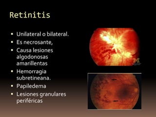 Retinitis
 Unilateral o bilateral.
 Es necrosante,
 Causa lesiones
algodonosas
amarillentas
 Hemorragia
subretineana.
...
