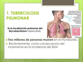 1. TUBERCULOSIS
PULMONAR
 Tres millones de personas mueren en el mundo/dia.
 Recientemente, como consecuencia del
incremento en la incidencia del SIDA
Es la localización pulmonar del
Mycobacterium tuberculosis.
 