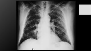 Infiltrado retículo-nodular
 