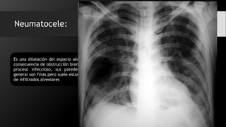 Neumatocele:
Es una dilatación del espacio aéreo como
consecuencia de obstrucción bronquial por
proceso infeccioso, sus paredes por lo
general son finas pero suele estar rodeado
de infiltrados alveolares
 