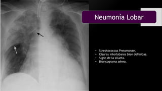 Neumonía Lobar
• Streptococcus Pneumonae.
• Cisuras interlobares bien definidas.
• Signo de la silueta.
• Broncograma aéreo.
 