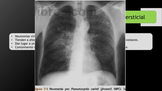 Neumonía Intersticial
• Neumonías víricas y micóticas.
• Tienden a afectar las paredes de las vías respiratorias así como de los tabiques alveolares.
• Dan lugar a un patrón reticular fino en los pulmones en rx.
• Comúnmente se diseminan a todo el pulmón con aspecto parcheado o confluyente.
 