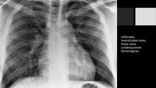 Neumonías Virales
Infiltrados
intersticiales leves,
hasta como
condensaciones
hemorrágicas.
 