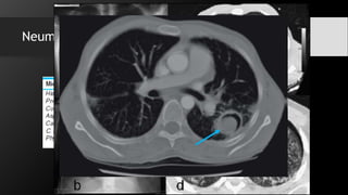 Neumonía micótica:
 