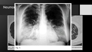 Neumonías por Hipersensibilidad:
 