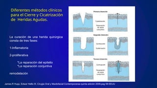 Diferentes métodos clínicos
para el Cierre y Cicatrización
de Heridas Agudas.
La curación de una herida quirúrgica
consta de tres fases:
1-Inflamatoria
2-proliferativa
*La reparación del epitelio
*La reparación conjuntiva
remodelación
James.R Hupp, Edwar Hellis III, Cirugia Oral y Maxilofacial Contemporanea quinta edición 2009,pag 58 EEUU
 