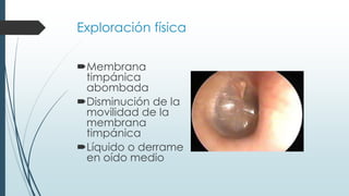 Exploración física
Membrana
timpánica
abombada
Disminución de la
movilidad de la
membrana
timpánica
Líquido o derrame
en oído medio
 