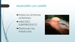 Mastoiditis con osteítis
Todos los síntomas
anteriores:
ABSCESO
SUBPERIOSTICO
Destruyen las
trabéculas
 