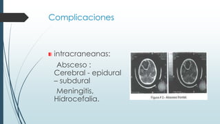 Complicaciones
intracraneanas:
Absceso :
Cerebral - epidural
– subdural
Meningitis,
Hidrocefalia.
 