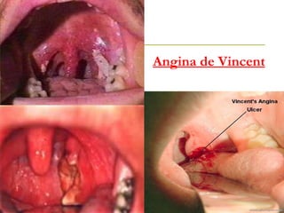 Angina de Vincent 