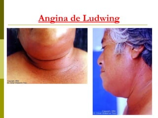 Angina de Ludwing 
