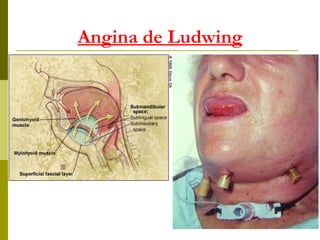 Angina de Ludwing 
