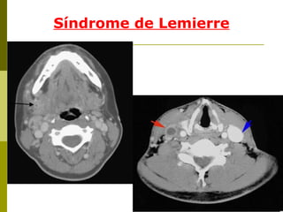 Síndrome de Lemierre 