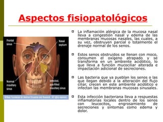 Aspectos fisiopatológicos La inflamación alérgica de la mucosa nasal lleva a congestión nasal y edema de las membranas mucosas nasales, las cuales, a su vez, obstruyen parcial o totalmente el drenaje normal de los senos.  Estos senos obstruidos se llenan con moco, consumen el oxígeno atrapado y se transforma en un ambiente acidótico, lo que lleva a función mucociliar alterada e impactación adicional de secreciones.  Las bacteria que ya pueblan los senos o las que llegan debido a la alteración del flujo ciliar, crecen en este ambiente acidótico e infectan las membranas mucosas sinusales.  Esta infección bacteriana lleva a respuestas inflamatorias locales dentro de los senos con leucocitos, engrosamiento de secreciones y síntomas como edema y dolor.  