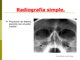 Radiografía simple. Proyección de Waters, paciente con sinusitis maxilar. ©  Faculty of Medicine, University of Szeged 