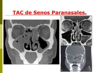 TAC de Senos Paranasales. 