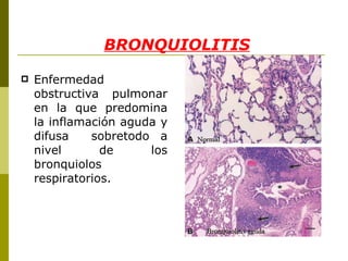 BRONQUIOLITIS Enfermedad obstructiva pulmonar en la que predomina la inflamación aguda y difusa  sobretodo a nivel de los bronquiolos respiratorios. 