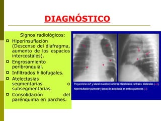 DIAGNÓSTICO Signos radiológicos: Hiperinsuflación (Descenso del diafragma, aumento de los espacios intercostales). Engrosamiento peribronquial.  Infiltrados hiliofugales.  Atelectasias segmentarias o subsegmentarias. Consolidación del parénquima en parches. 