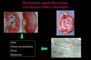 Pielonefritis aguda Bacteriana
Correlacíon Clínico-Patológica
Dolor
Fiebre con escalofrios
Piuria
Bacteriuria
 