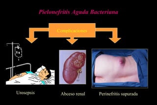 Complicaciones
Pielonefritis Aguda Bacteriana
Perinefritis supuradaAbceso renalUrosepsis
 