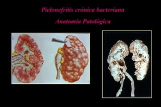 Pielonefritis crónica bacteriana
Anatomía Patológica
 