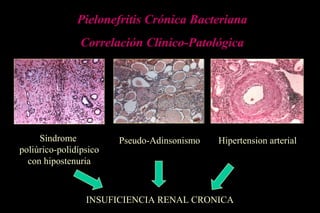 Pielonefritis Crónica Bacteriana
Correlación Clínico-Patológica
Síndrome
poliúrico-polidípsico
con hipostenuria
Pseudo-Adinsonismo Hipertension arterial
INSUFICIENCIA RENAL CRONICA
 