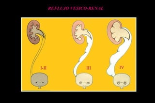 REFLUJO VESICO-RENAL
I-II III IV
 
