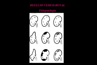REFLUJO VESICO-RENAL
Fisiopatología
 