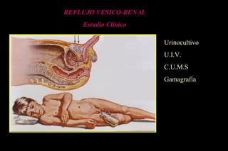 REFLUJO VESICO-RENAL
Estudio Clínico
Urinocultivo
U.I.V.
C.U.M.S
Gamagrafía
 