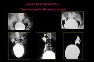 REFLUJO VESICO-RENAL
Cisto Uretrografías Miccionales seriadas
 