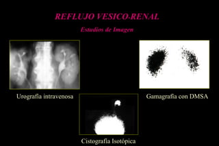 REFLUJO VESICO-RENAL
Estudios de Imagen
Urografía intravenosa Gamagrafía con DMSA
Cistografía Isotópica
 