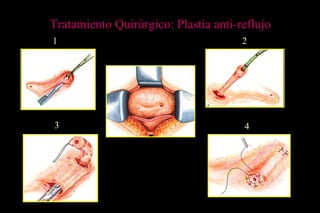 1 2
3 4
Tratamiento Quirúrgico: Plastia anti-reflujo
 