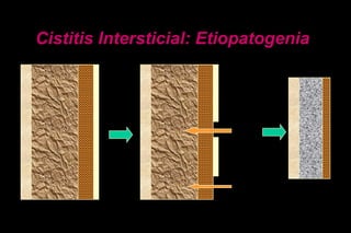 Cistitis Intersticial: Etiopatogenia
 