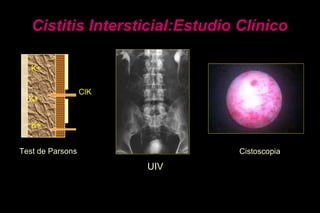 Test de Parsons
ClK
K+
K+
K+
Cistoscopia
Cistitis Intersticial:Estudio Clínico
UIV
 