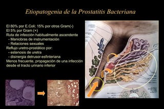 Etiopatogenia de la Prostatitis Bacteriana
El 80% por E.Coli; 15% por otros Gram(-)
El 5% por Gram (+)
Ruta de infección habitualmente ascendente
- Maniobras de instrumentación
- Relaciones sexuales
Reflujo uretro-prostático por:
- estenosis de uretra
- disinergia detrusor-esfinteriana
Menos frecuente, propagación de una infección
desde el tracto urinario inferior
 