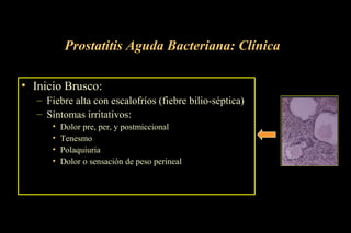 Prostatitis Aguda Bacteriana: Clínica
• Inicio Brusco:
– Fiebre alta con escalofríos (fiebre bilio-séptica)
– Síntomas irritativos:
• Dolor pre, per, y postmiccional
• Tenesmo
• Polaquiuria
• Dolor o sensación de peso perineal
 