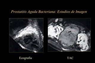 Prostatitis Aguda Bacteriana: Estudios de Imagen
Ecografía TAC
 