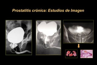Prostatitis crónica: Estudios de Imagen
 