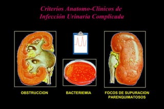 BACTERIEMIAOBSTRUCCION FOCOS DE SUPURACION
PARENQUIMATOSOS
Criterios Anatomo-Clínicos de
Infección Urinaria Complicada
 