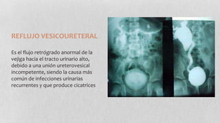 REFLUJO VESICOURETERAL
Es el flujo retrógrado anormal de la
vejiga hacia el tracto urinario alto,
debido a una unión ureterovesical
incompetente, siendo la causa más
común de infecciones urinarias
recurrentes y que produce cicatrices

 