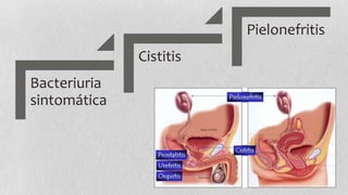 Pielonefritis
Cistitis
Bacteriuria
sintomática

 